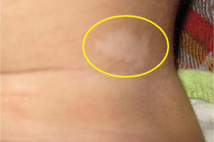 无色素痣后颈症状图 无色素痣后颈症状图