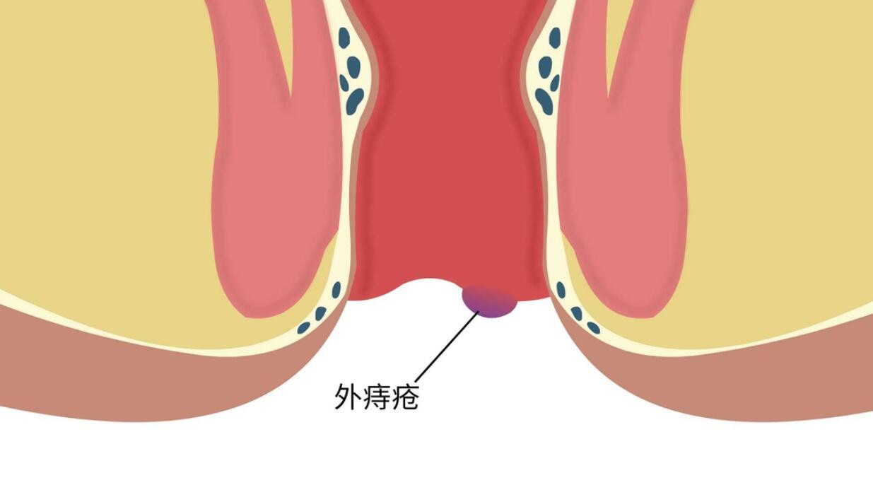 什么是外痔疮图片大全