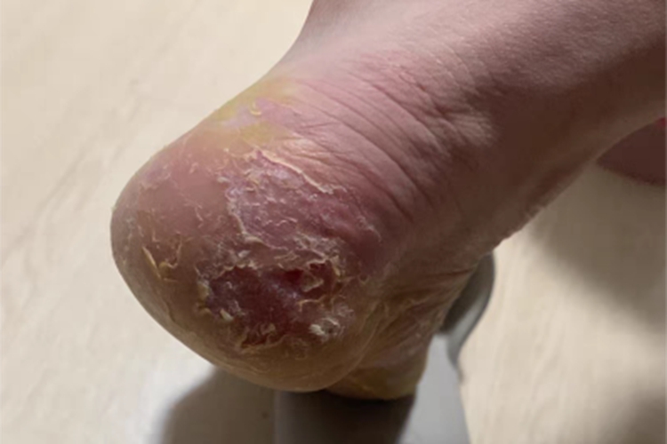 鳞屑角化型足癣皮肤粗糙图