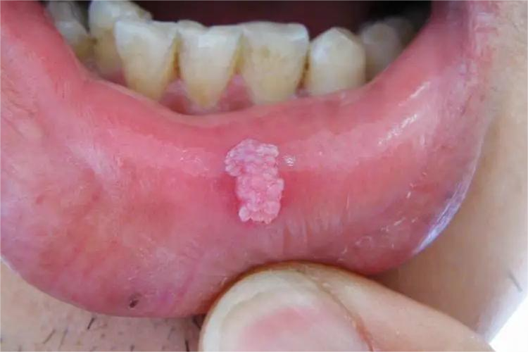 尖锐湿疣下嘴唇疣体图 尖锐湿疣下嘴唇疣体图