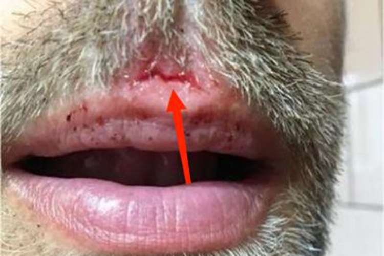 深在型须癣口周有裂口图