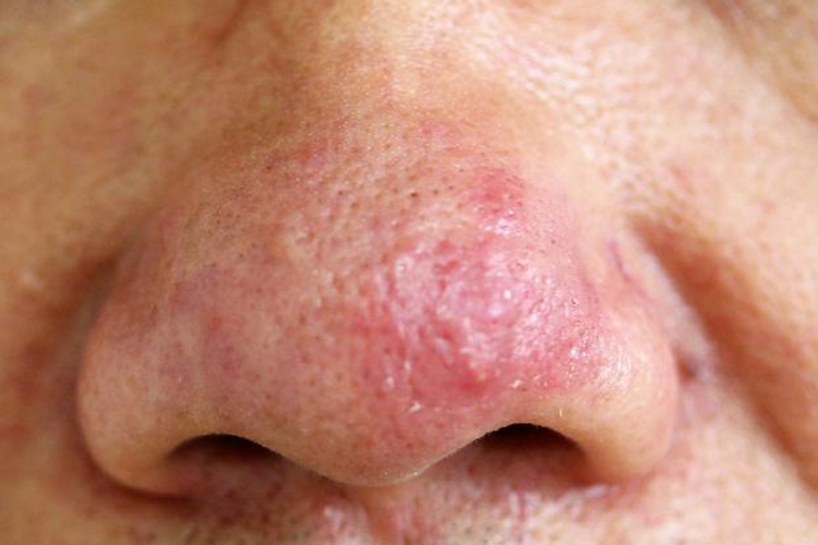 面部蠕形螨病酒渣鼻图