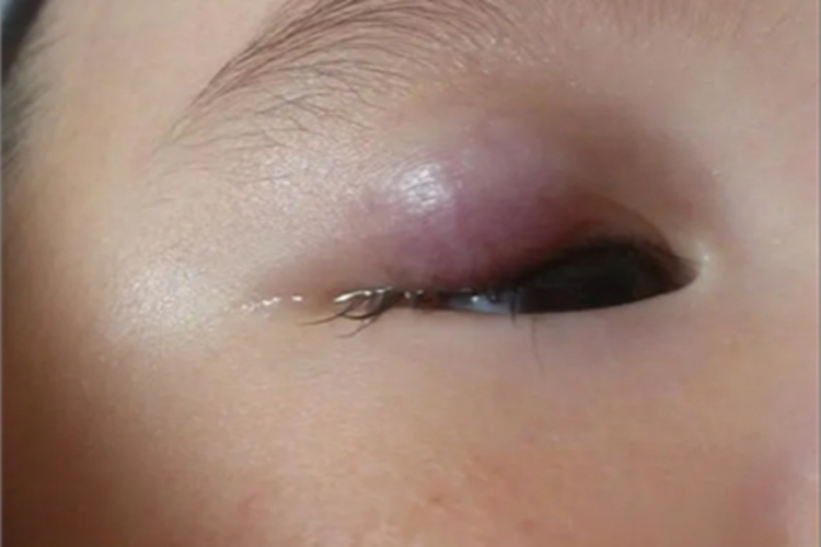 霰粒肿眼睑症状图