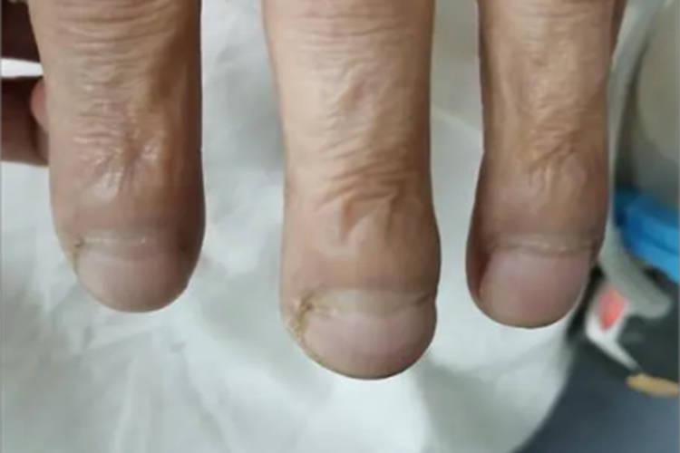 杵状指手指甲板增大图