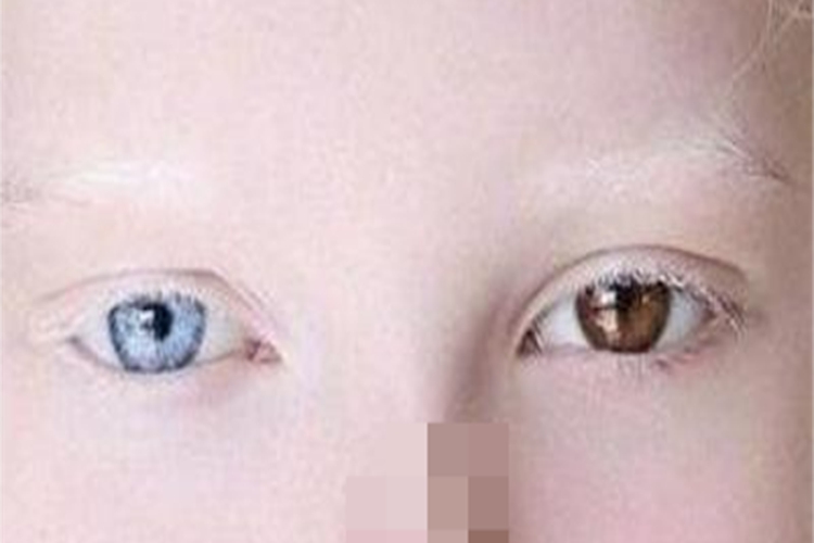 虹膜异色两眼颜色各异图