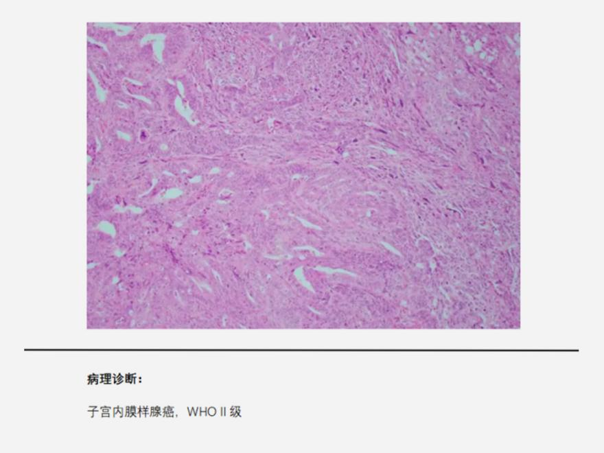 子宫内膜样腺癌（46岁女性患子宫内膜样腺癌，月经异常要警惕！）.png