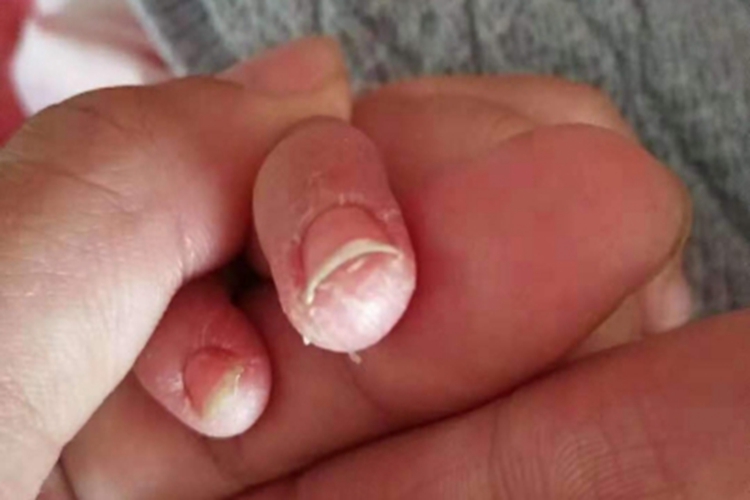 川崎病手指尖上有脱皮图