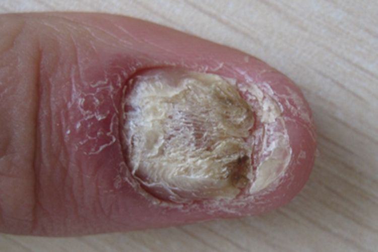 银屑病甲脱皮图