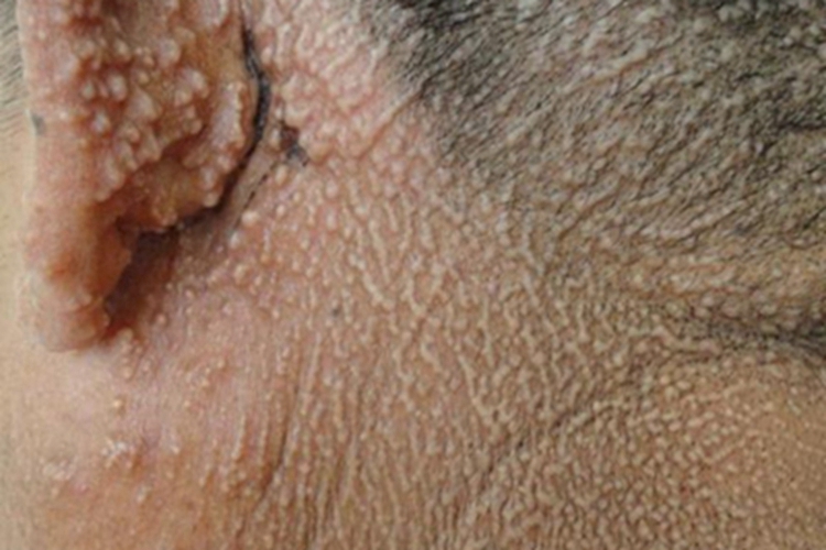 黏液水肿性苔藓耳后长丘疹图