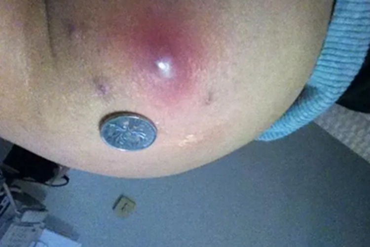 热带痤疮臀部有大脓包图