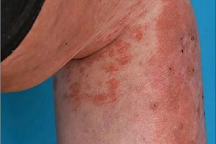 落叶型天疱疮腿红斑图