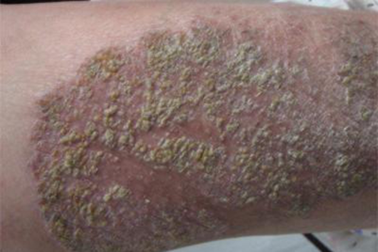 亚急性湿疹胳膊皮肤颜色加深图 亚急性湿疹胳膊皮肤颜色加深图