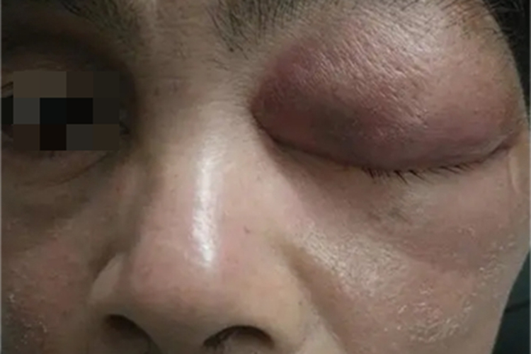 眼眶血肿眼部肿图 眼眶血肿眼部肿图