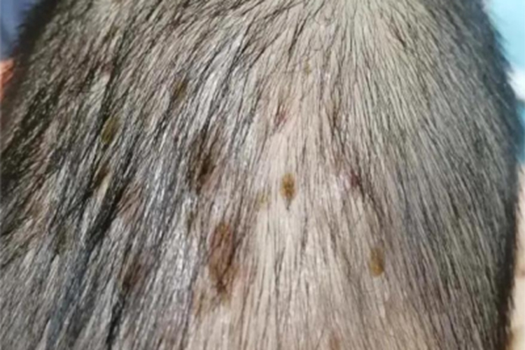 勒-雪病头皮长皮疹图