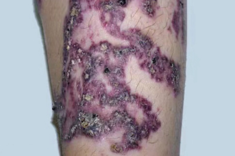 局限性血管角化瘤小腿结节紫斑图 局限性血管角化瘤小腿结节紫斑图