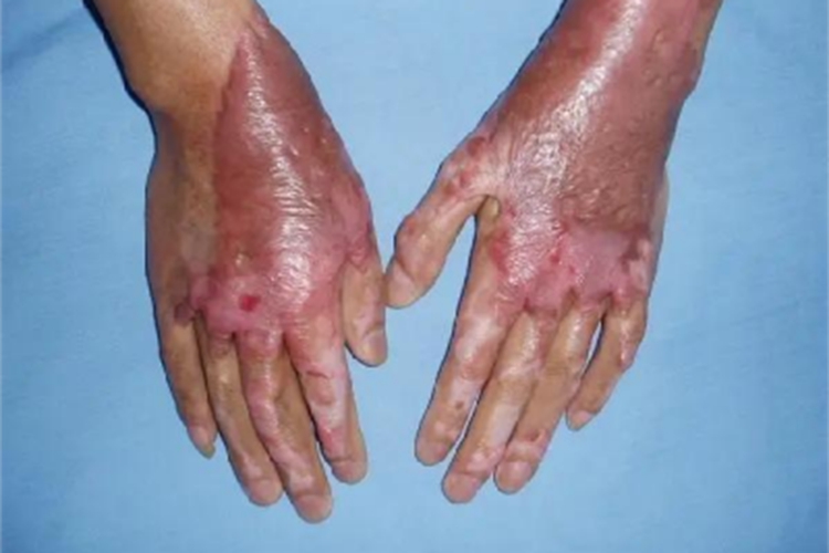 深Ⅱ度烧伤手部症状图