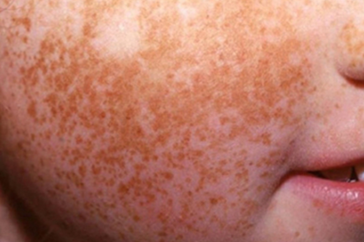 日光性雀斑样痣面部症状图 日光性雀斑样痣面部症状图