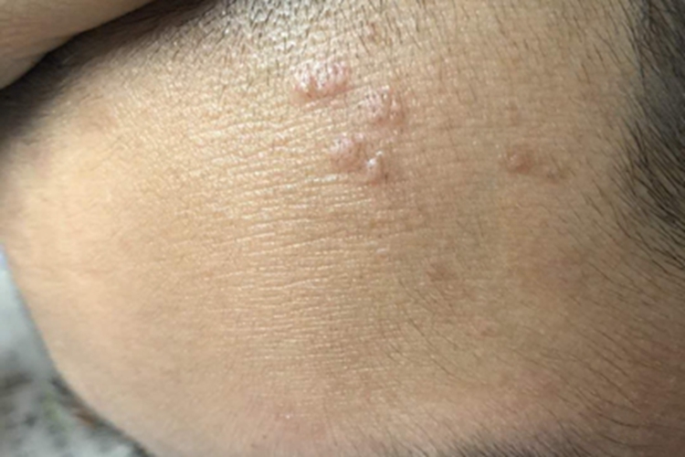 扁平疣额头长了几个小疙瘩图