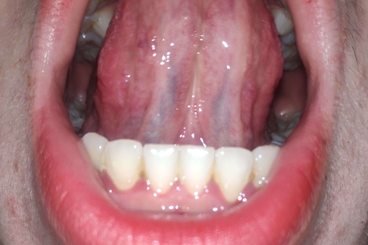 正常舌下静脉图