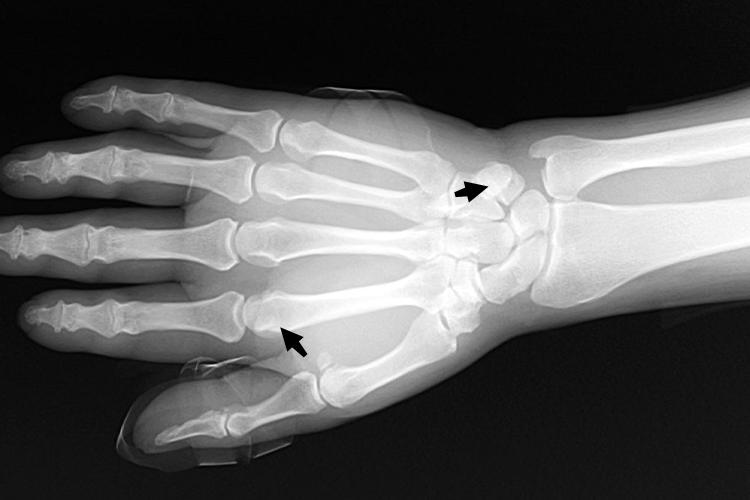 手籽骨位置图 手籽骨位置图