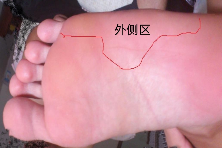 脚底外侧区图 脚底外侧区图