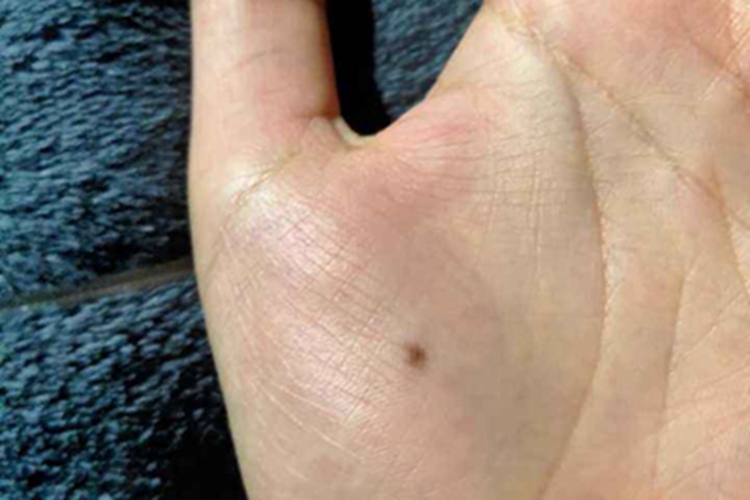 交界痣手掌斑图