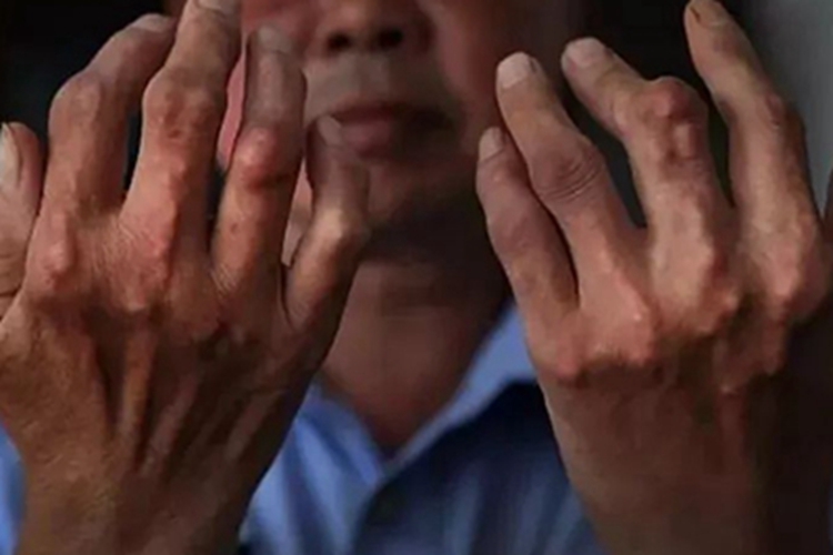 痛风手指上长好多硬结节图 痛风手指上长好多硬结节图