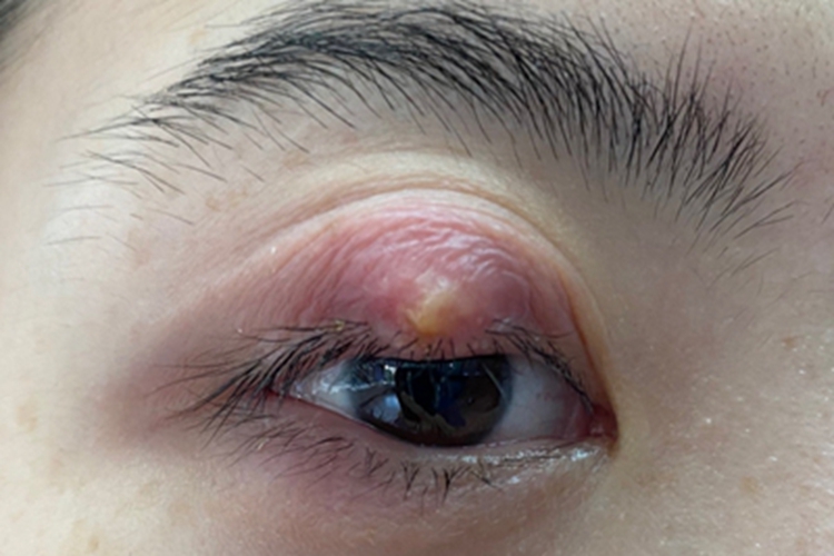 外睑腺炎眼睑长疖图