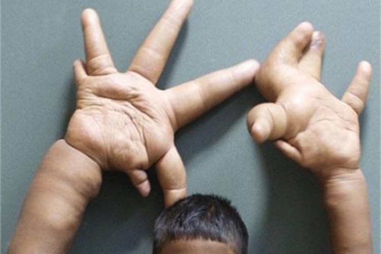 巨指畸形双侧手指粗大图 巨指畸形双侧手指粗大图