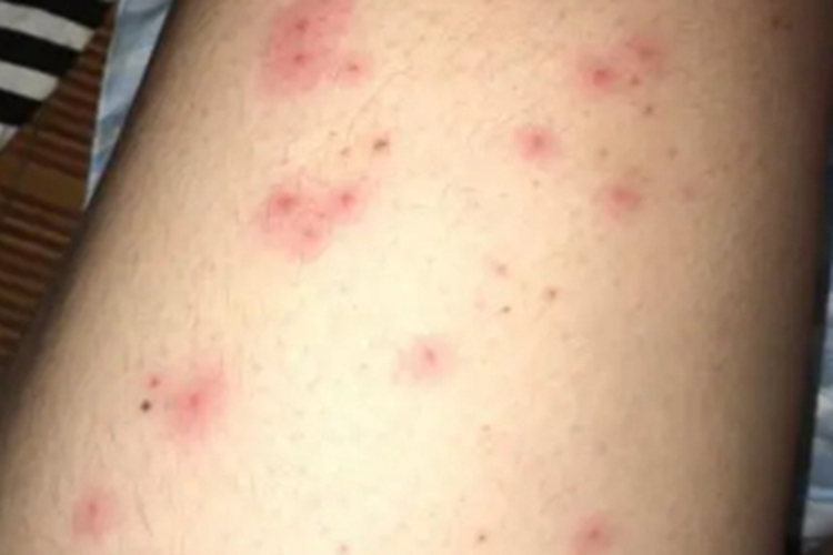 热带痤疮大腿症状图