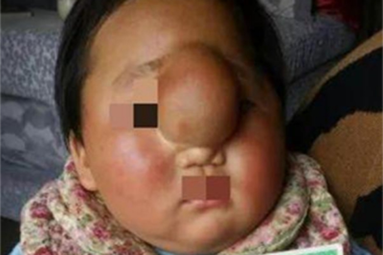 显性颅裂鼻部症状图