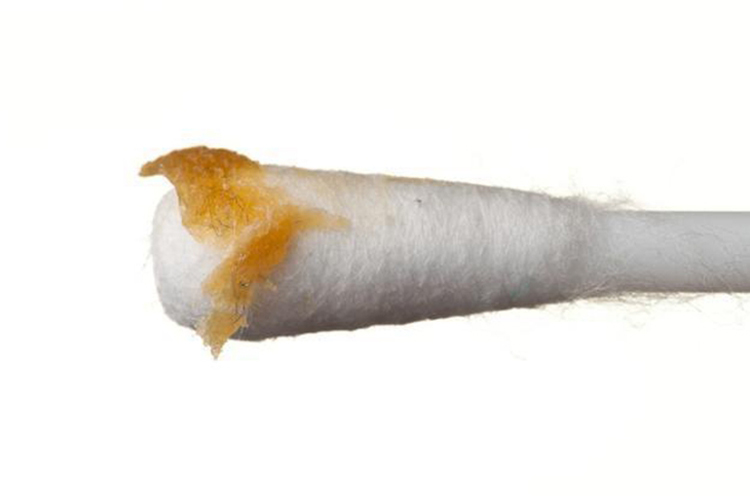片状耵聍图