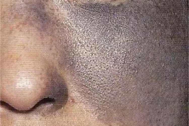 太田痣左侧面部长满斑点图 太田痣左侧面部长满斑点图