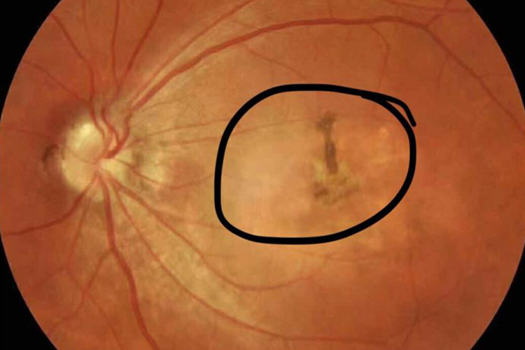 近视性黄斑变性图