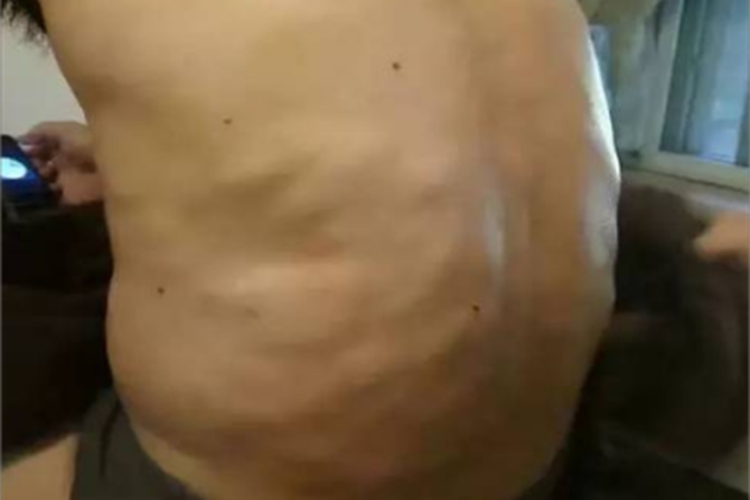 Ⅲ型痛性肥胖病症状图 Ⅲ型痛性肥胖病症状图