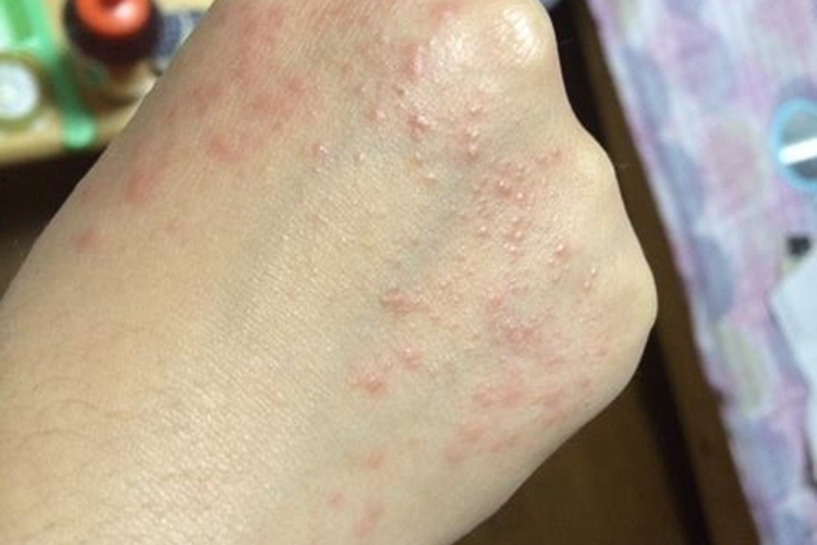 急性接触性皮炎手部丘疹图