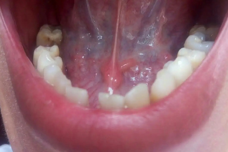 单纯疱疹舌根水疱图