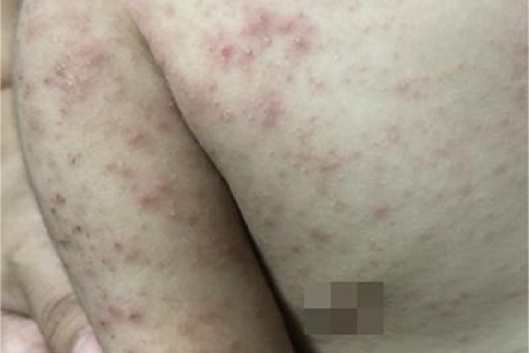 夏季皮炎胳膊丘疹结痂图 夏季皮炎胳膊丘疹结痂图