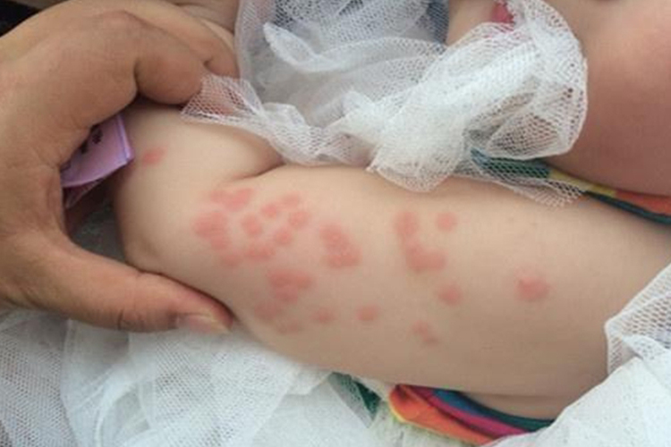 跳蚤叮咬诱发荨麻疹图 跳蚤叮咬诱发荨麻疹图