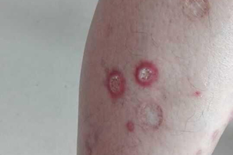 丘疹坏死性结核疹溃疡图