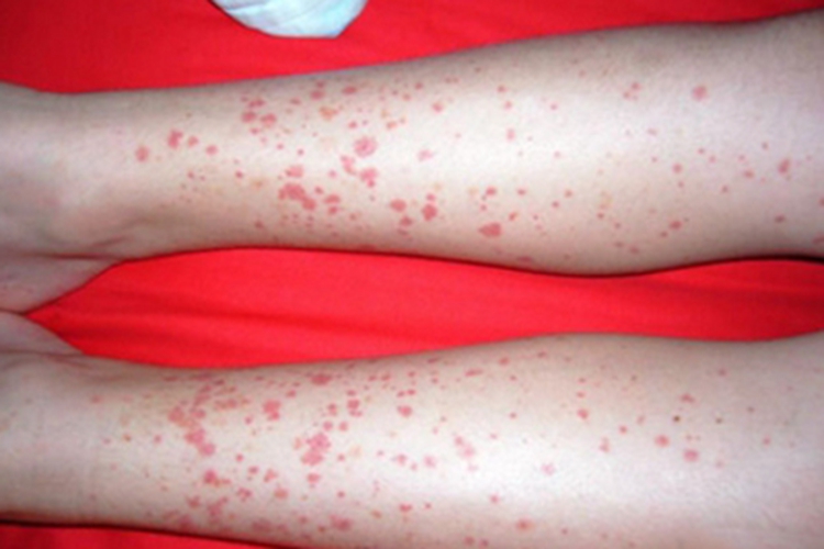 血管内压力增多性紫癜小腿红点图