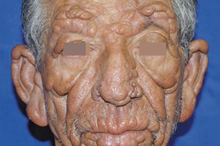瘤型麻风面部症状图 瘤型麻风面部症状图