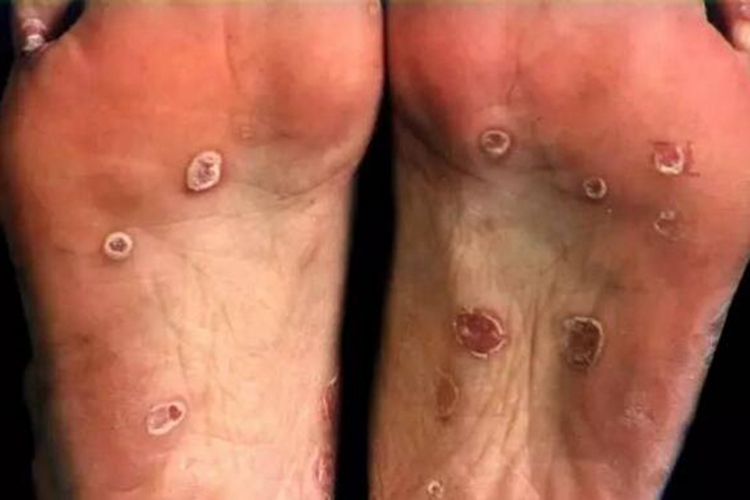 掌跖部位梅毒疹图 掌跖部位梅毒疹图