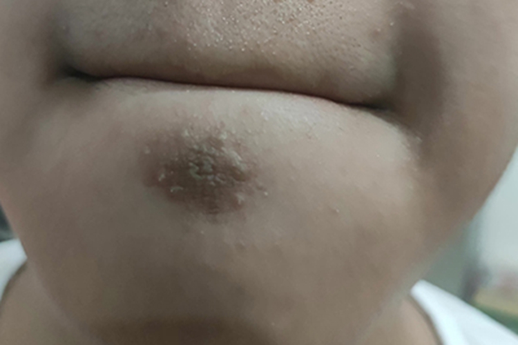 皮肤垢着病下巴症状图