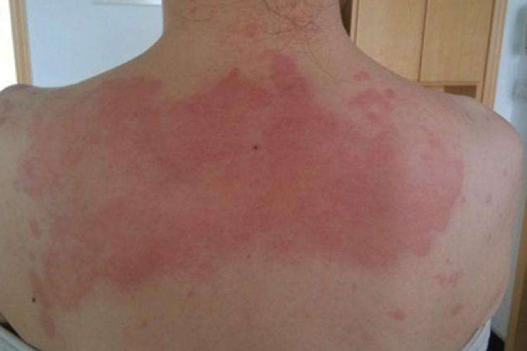 太阳暴晒后起红斑图