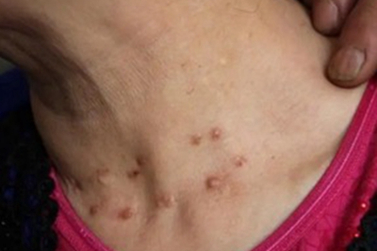 多发性脂囊瘤颈部结节图