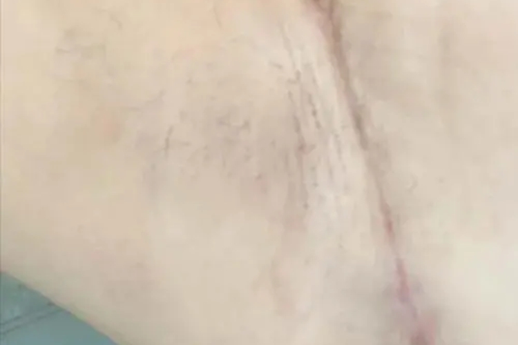 副乳切除后疤痕图 副乳切除后疤痕图