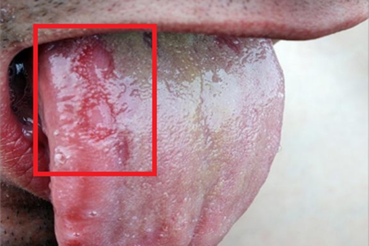 男性三期梅毒舌头症状图