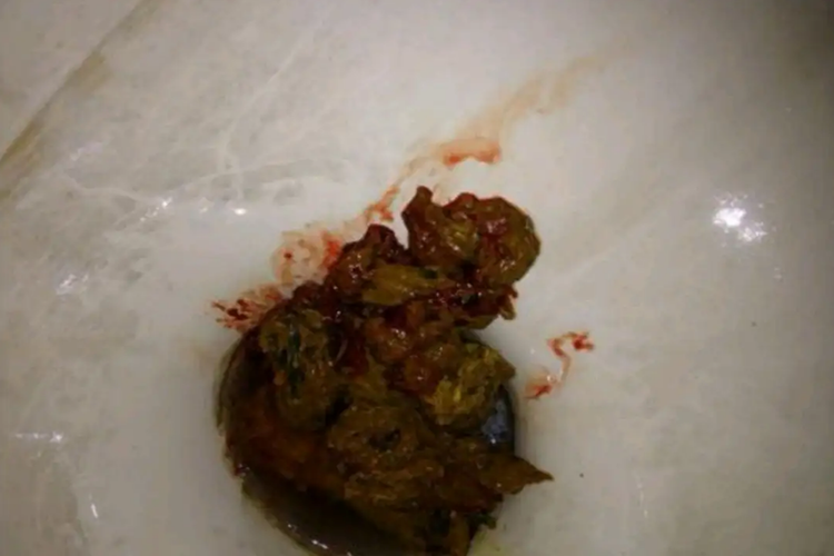 大便排出带血图