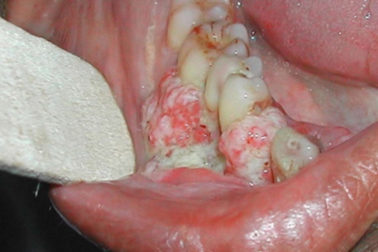 牙龈癌图